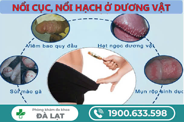 NỔI HẠCH DƯƠNG VẬT